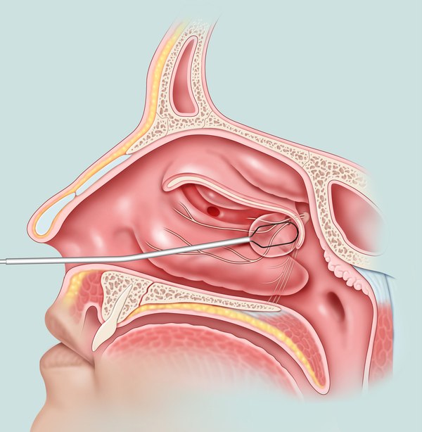 How ClariFix treats the posterior nasal nerve
