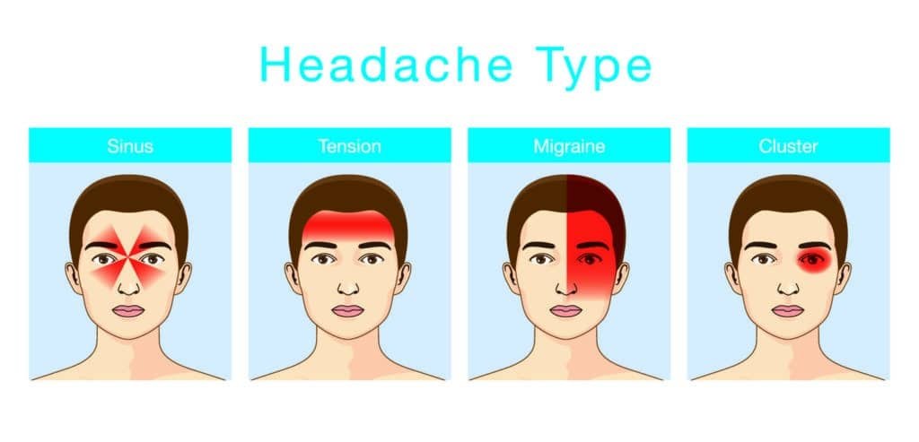 Types of headaches. Illustrated guide showing the typical pain patterns for Sinus, Tension, Migraine, and Cluster headaches.