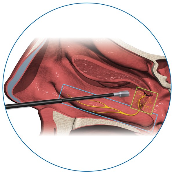 How RhinAer treats the posterior nasal nerve